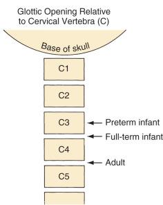 FIGURE 14.1, In a preterm Infant, the larynx is located at the middle of the third cervical vertebra (C3); in a full-term infant, it is at the C3-4 interspace; and in an adult, it is at the C4-5 interspace.