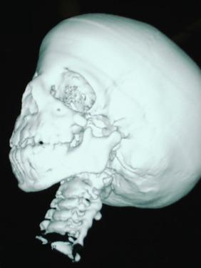 FIGURE 14.2, Three-dimensional reconstruction of a child with the Treacher Collins anomaly demonstrates the retrognathic and more posterior position of the mandible, the midfacial hypoplasia, and the closer proximity and exaggerated angle between the base of the tongue and the laryngeal inlet (almost 90 degrees), which makes direct visualization of the larynx difficult.