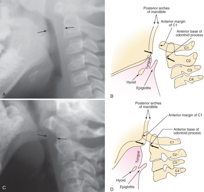 FIGURE 14.3, The larynx in children with mandibular hypoplasia is located more posteriorly than in children with normal anatomy. A, Lateral radiograph of the upper airway including the base of the skull and cervical spine of a normal 7-year-old child; the arrows denote the posterior border of the ramus of the mandible and the anterior border of the second cervical vertebra. B, Diagrammatic representation of the normal anatomy in A . C, The same radiographic projection in a 6-year-old child with Treacher Collins syndrome; the arrows again denote the posterior border of the ramus of the mandible and the anterior margin of the second cervical vertebra. D, Diagrammatic representation of the anatomy in C . Notice the significantly smaller space between the ramus of the mandible and the second cervical vertebra, compared with the normal anatomy; the anterior margin of the first cervical vertebra overlaps the posterior margin of the mandible. This extreme posterior location of the tongue and larynx makes direct visualization of the laryngeal inlet almost impossible in many children with this anomaly because of the acute angulation between the base of the tongue and the laryngeal inlet.