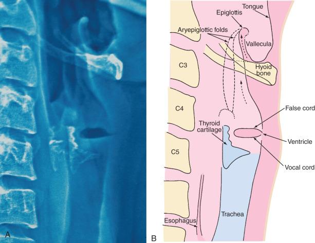 FIGURE 14.4, Lateral neck xerogram (A) and schematic diagram (B) of the larynx in an adult. Notice the relatively thin, broad epiglottis, the axis of the epiglottis which is parallel to the trachea. The hyoid bone “hugs” the epiglottis; there is no subglottic narrowing. Also note how the vocal cords are perpendicular to the axis of the trachea.