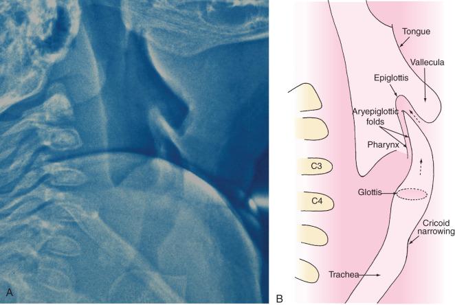 FIGURE 14.5, Lateral neck xerogram (A) and schematic diagram (B) of an infant's larynx. Notice the angled epiglottis and the narrow cricoid cartilage. Also note that the vocal cords are angled with a higher attachment anteriorly than posteriorly compared with the perpendicular position of the vocal cords in adults.