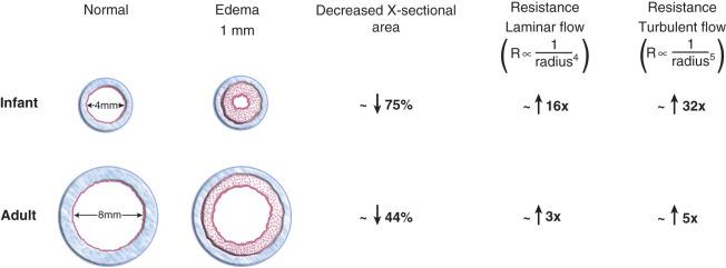 FIGURE 14.7, Relative effects of airway edema in an infant and an adult. The normal airways of an infant and an adult are presented on the left. Edematous airways display 1 mm of circumferential edema, reducing the diameter of the lumen by 2 mm. Notice that resistance to airflow is inversely proportional to the radius of the lumen to the fourth power for laminar flow (beyond the fifth bronchial division) and to the radius of the lumen to the fifth power for turbulent flow (from the mouth to the fourth bronchial division). The net result in an infant with a 4-mm diameter airway is a 75% reduction in cross-sectional area and a 16-fold increase in resistance to laminar airflow, compared with a 44% reduction in cross-sectional area and a 3-fold increased resistance in an adult with a similar 2-mm reduction in airway diameter. With turbulent airflow (upper airway), the resistance increases 32-fold in the infant but only 5-fold in the adult.