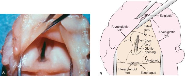 FIGURE 14.9, Photograph (A) and schematic diagram (B) of the larynx of a premature infant.