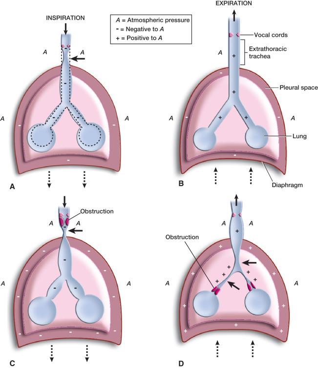 FIGURE 14.10, A, With descent of the diaphragm and contraction of the intercostal muscles, a greater negative intrathoracic pressure relative to intraluminal and atmospheric pressure is developed. The net result is longitudinal stretching of the larynx and trachea, dilatation of the intrathoracic trachea and bronchi, movement of air into the lungs, and some dynamic collapse of the extrathoracic trachea ( arrow ) . The dynamic collapse is due to the highly compliant trachea and the negative intraluminal pressure in relation to atmospheric pressure. B, The normal sequence of events at end-expiration is a slight negative intrapleural pressure stenting the airways open. In infants, the highly compliant chest does not provide the support required; therefore airway closure occurs with each breath. Intraluminal pressures are slightly positive in relation to atmospheric pressure, with the result that air is forced out of the lungs. C, Obstructed extrathoracic airway. Notice the severe dynamic collapse of the extrathoracic trachea below the level of obstruction. This collapse is greatest at the thoracic inlet, where the largest pressure gradient exists between negative intratracheal pressure and atmospheric pressure ( arrow ). (Extrathoracic upper airway obstruction is characterized by inspiratory stridor.) D, Obstructed intrathoracic trachea or airways. Notice that breathing against an obstructed lower airway (e.g., bronchiolitis, asthma) results in greater positive intrathoracic pressures, with dynamic collapse of the intrathoracic airways (prolonged expiration or wheezing [ arrows ]).