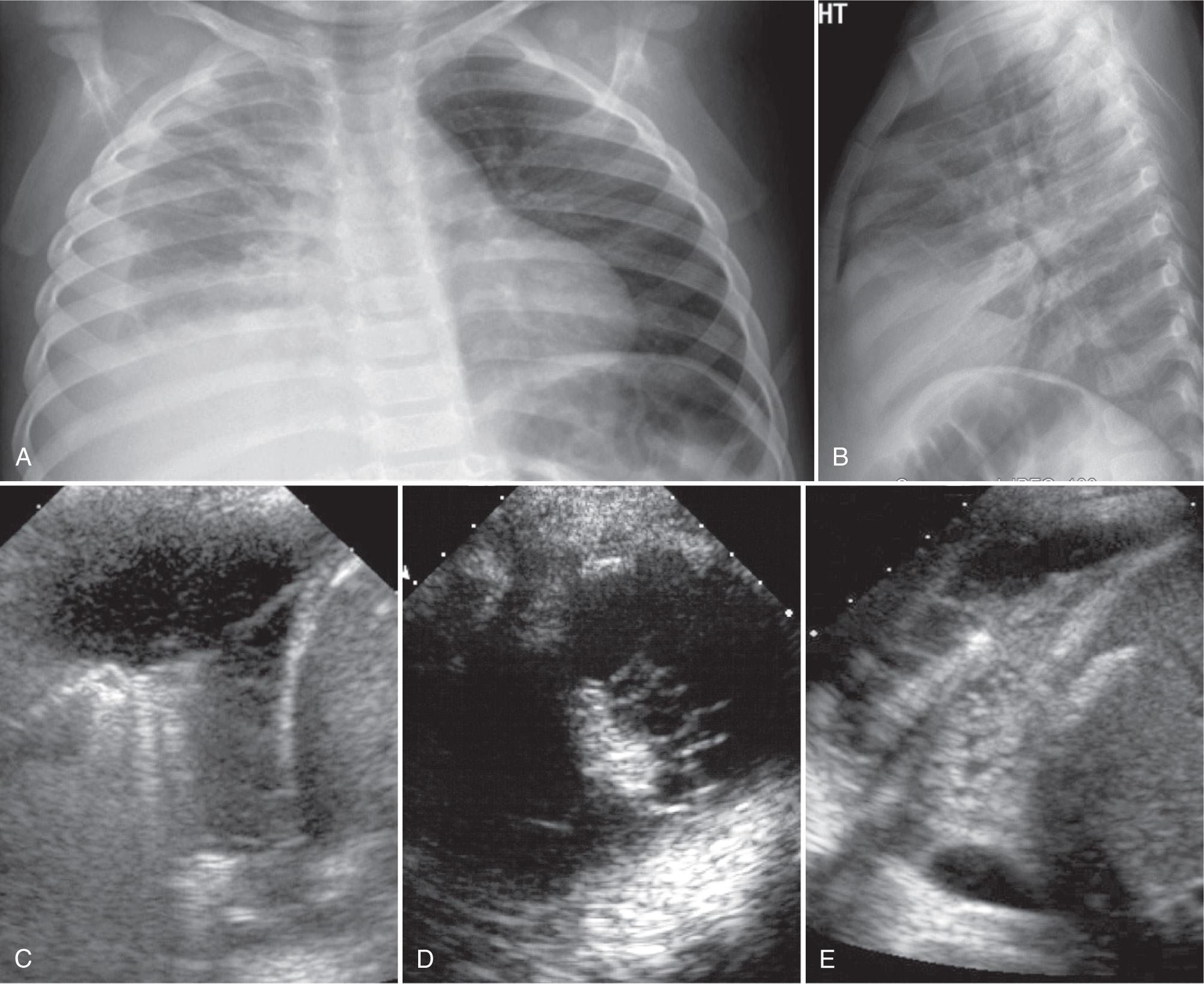 FIG. 50.11, Septated Pleural Fluid.