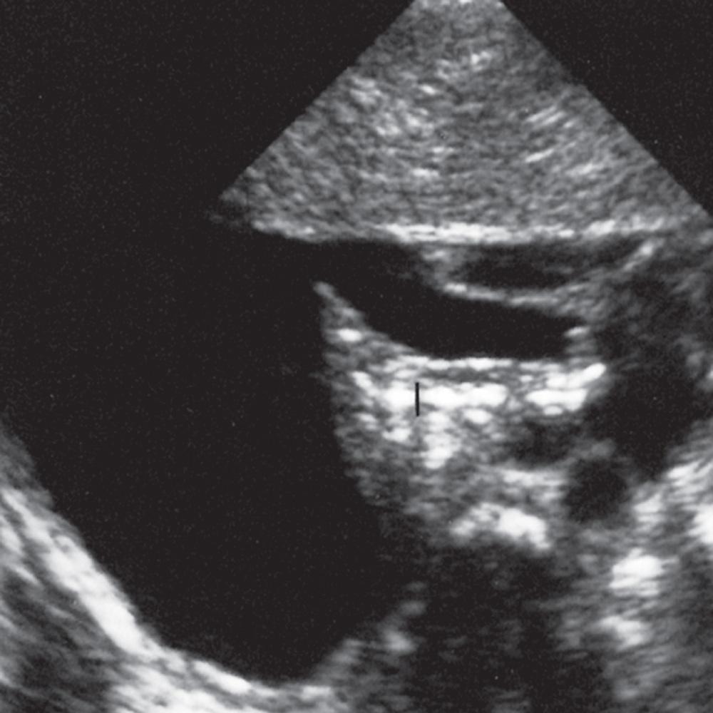 FIG. 50.12, Sonographic Air Bronchograms Within Pneumonia.