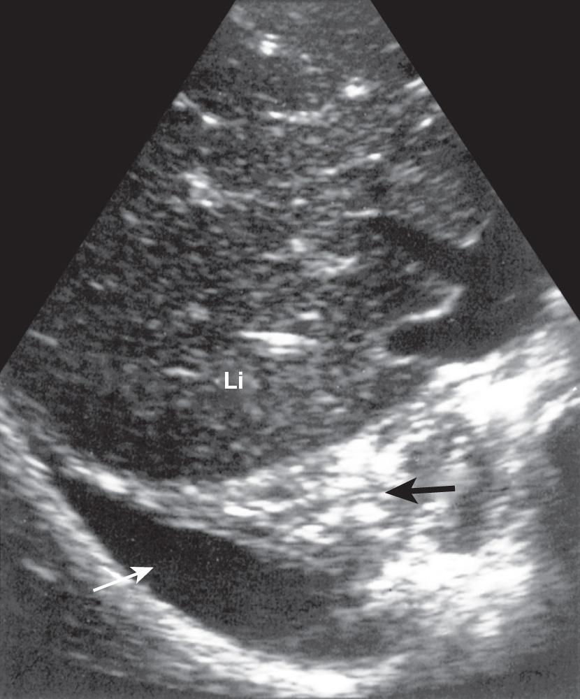 FIG. 50.13, Posterior Pleural Fluid Over Bare Area of Liver.