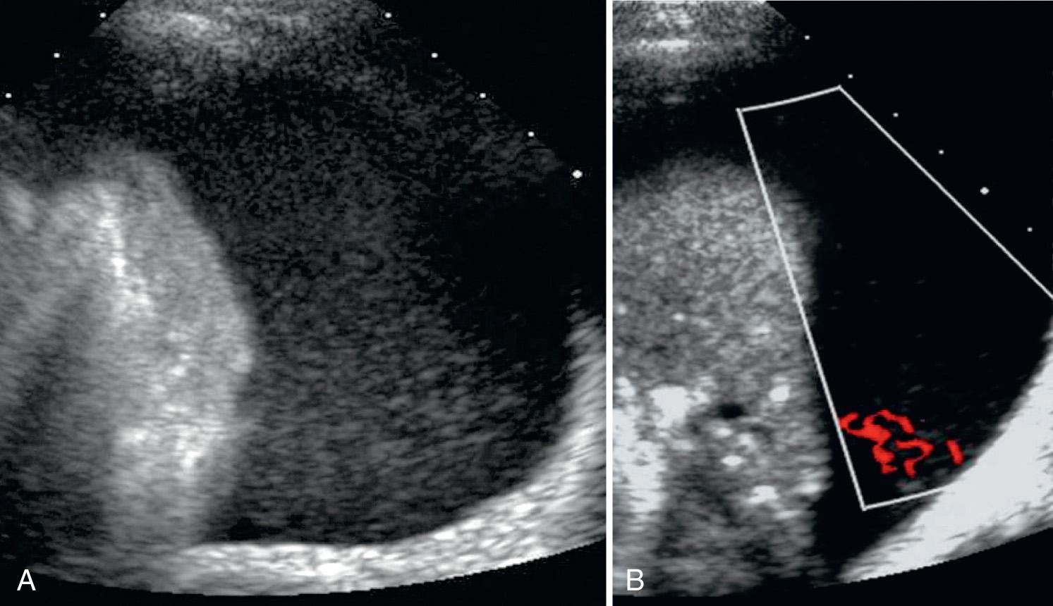 FIG. 50.14, Color Flow Doppler Signal in Pleural Fluid With Debris.