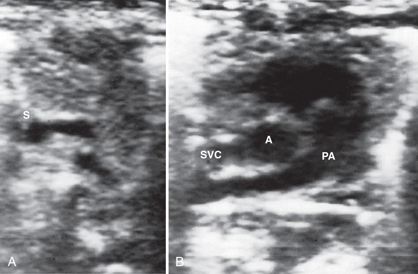 FIG. 50.3, Normal Mediastinum, Transverse View.