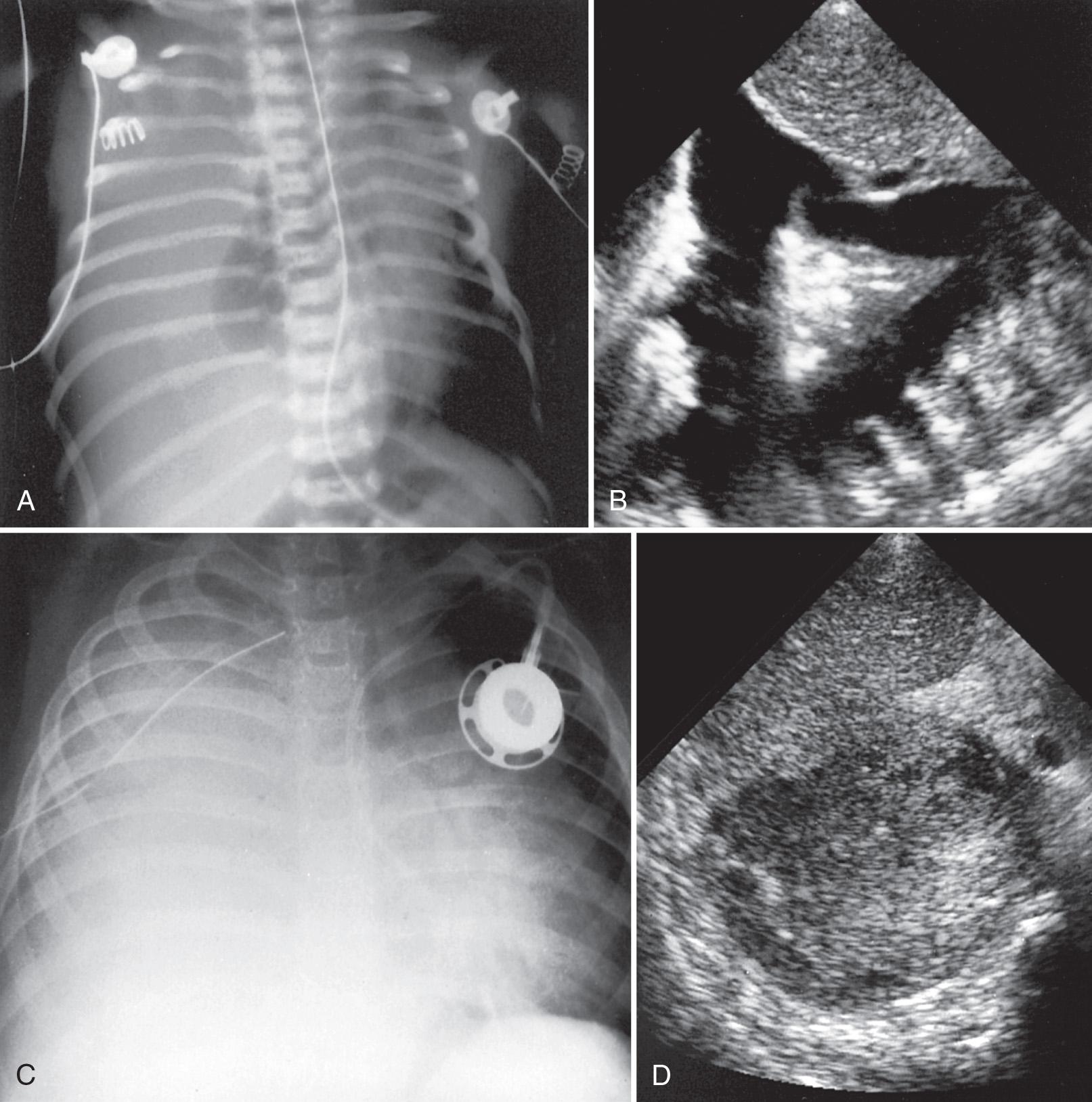 FIG. 50.4, Radiopaque Hemithorax: Neonatal Chylothorax.