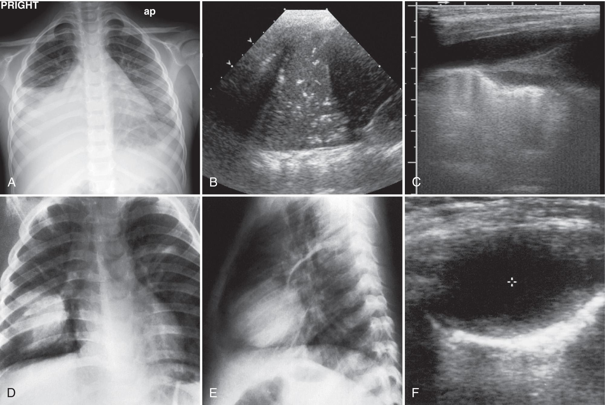 FIG. 50.5, Partially Radiopaque Hemithorax.