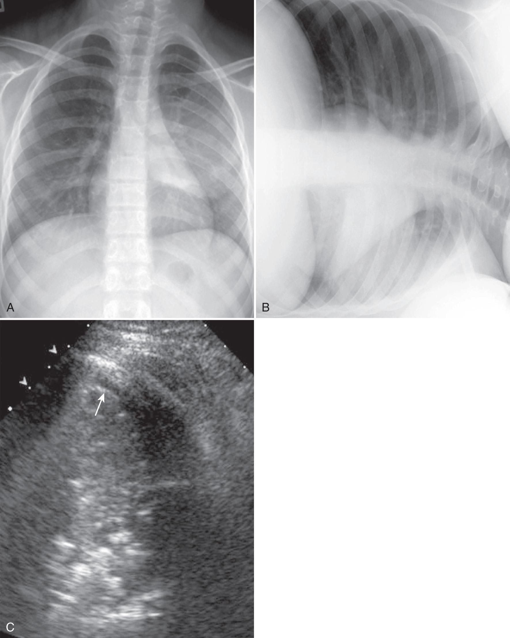 FIG. 50.6, Pneumonia With Small Amount of Pleural Fluid.
