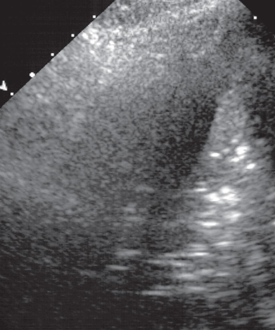 FIG. 50.9, Hemothorax.