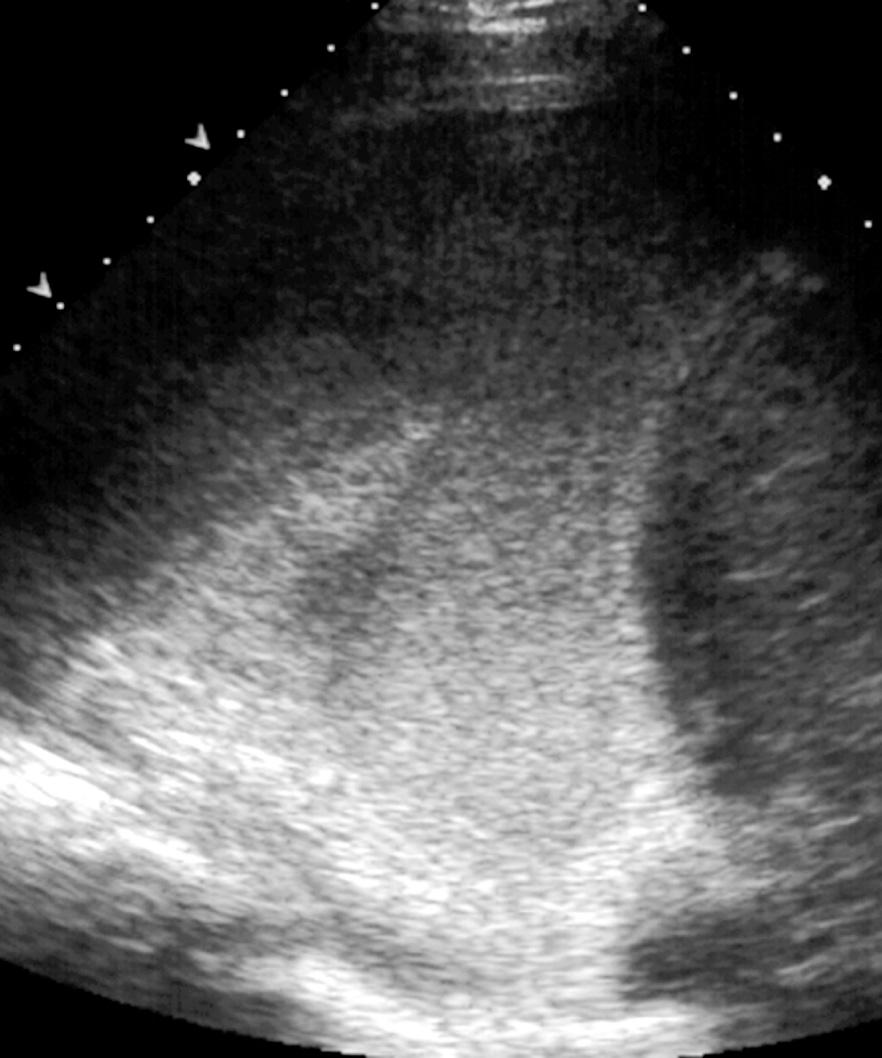 FIG. 50.10, Empyema Caused by Pneumonia.