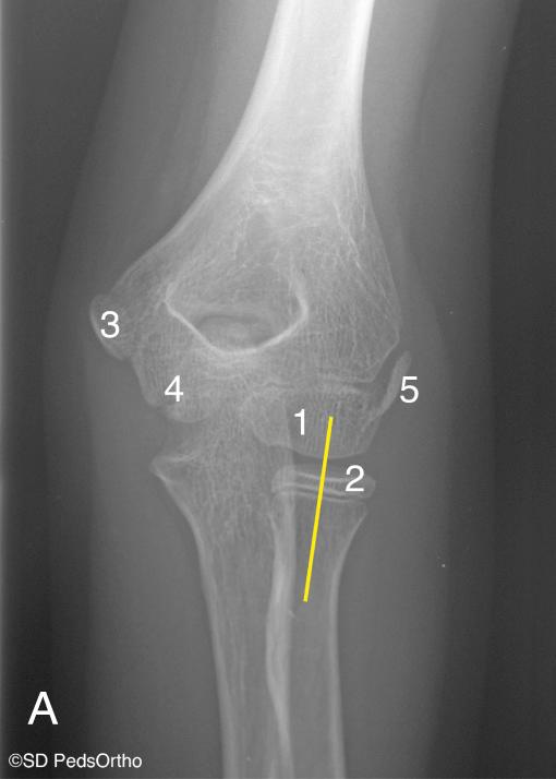 FIG 25.2, (A) Normal AP elbow radiograph showing radiocapitellar line ( yellow line ). 1, Capitellum ossification; 2 , radial head ossification; 3 , medial epicondyle ossification; 4, trochlea ossification; 5, lateral epicondyle ossification. (B) Normal lateral elbow radiograph showing radiocapitellar line ( yellow line ). 1, Capitellum ossification; 2, radial head ossification; 3, olecranon ossification. Fragmentation of ossification often mistaken as a fracture. (C) Displaced medial epicondyle no longer just below the olecranon fossa (*).