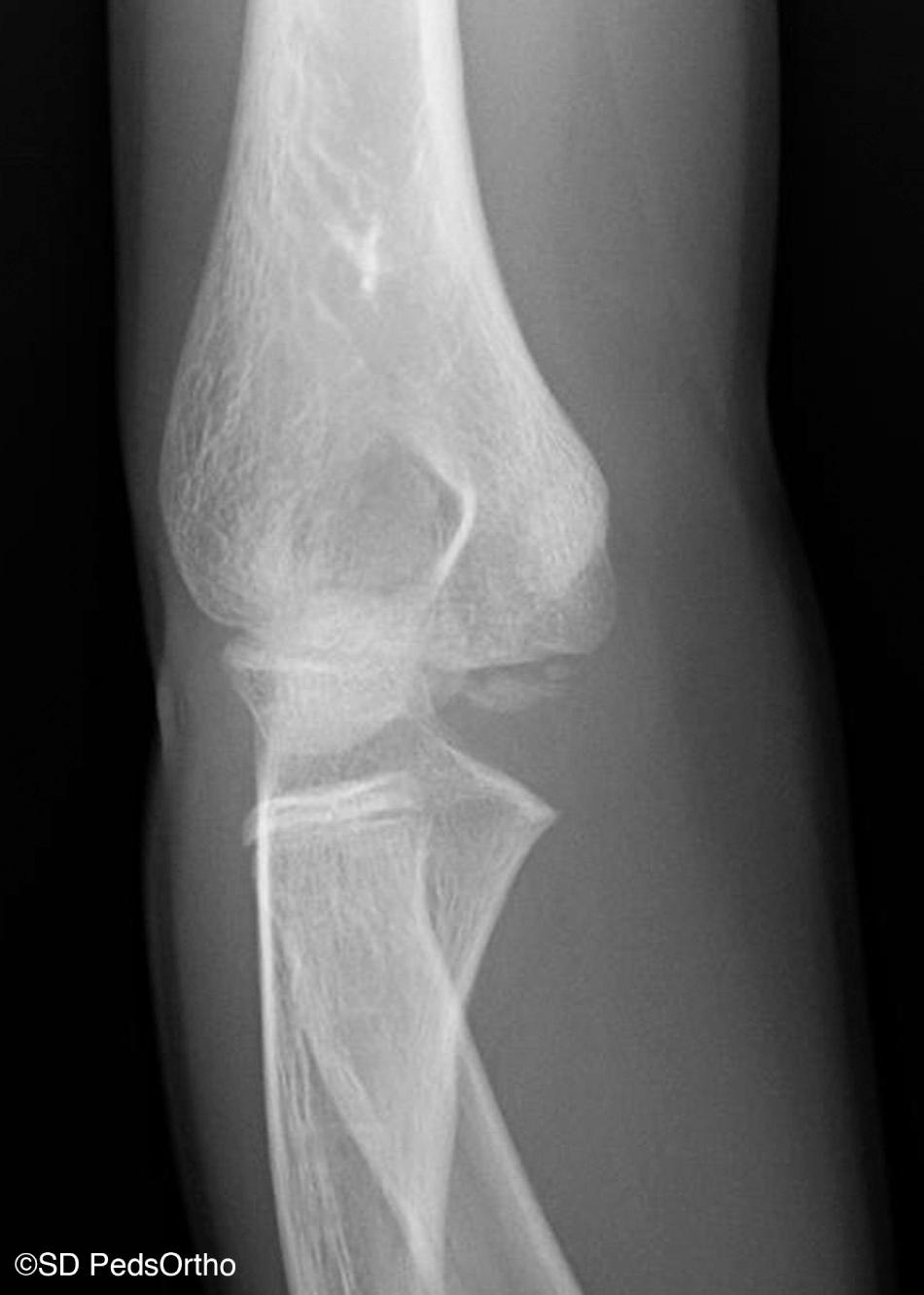 FIG 25.3, Oblique radiograph of elbow in 10-year-old boy demonstrating multiple foci of ossification within the trochlea, a common normal variant.