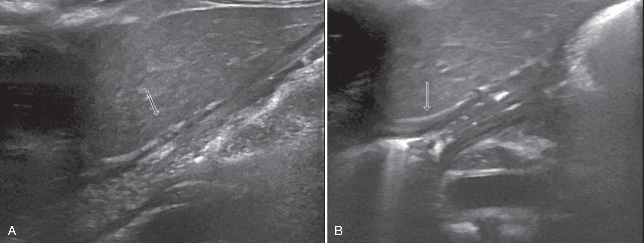 FIG. 53.1, Gastroesophageal Reflux.