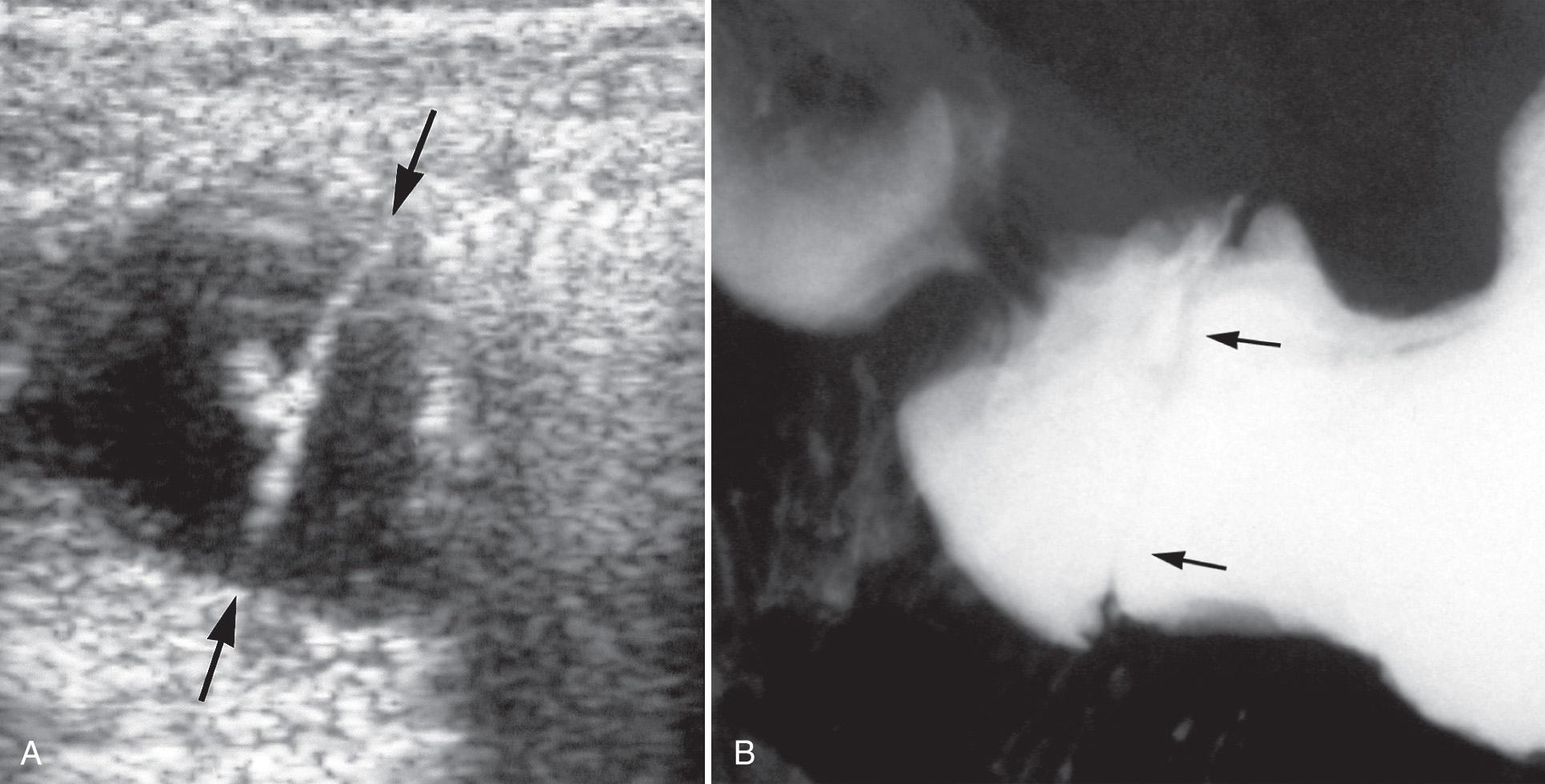 FIG. 53.11, Gastric Diaphragm.