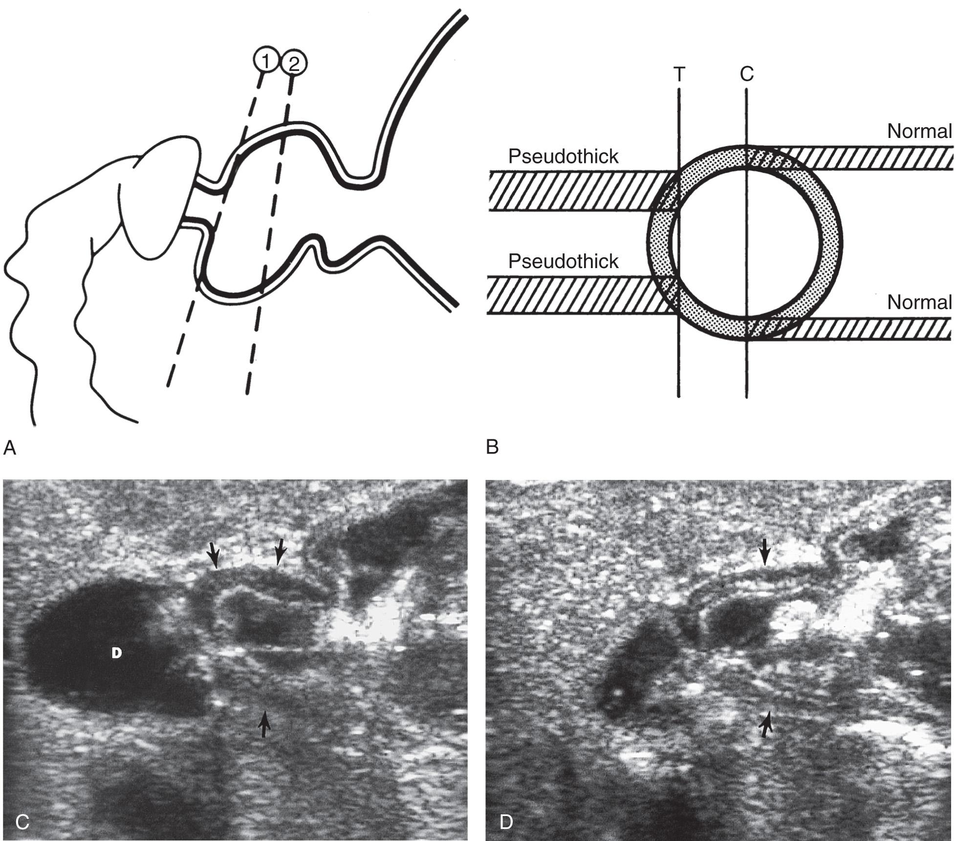 FIG. 53.4, Pyloric Muscle Tangential Imaging Artifacts.