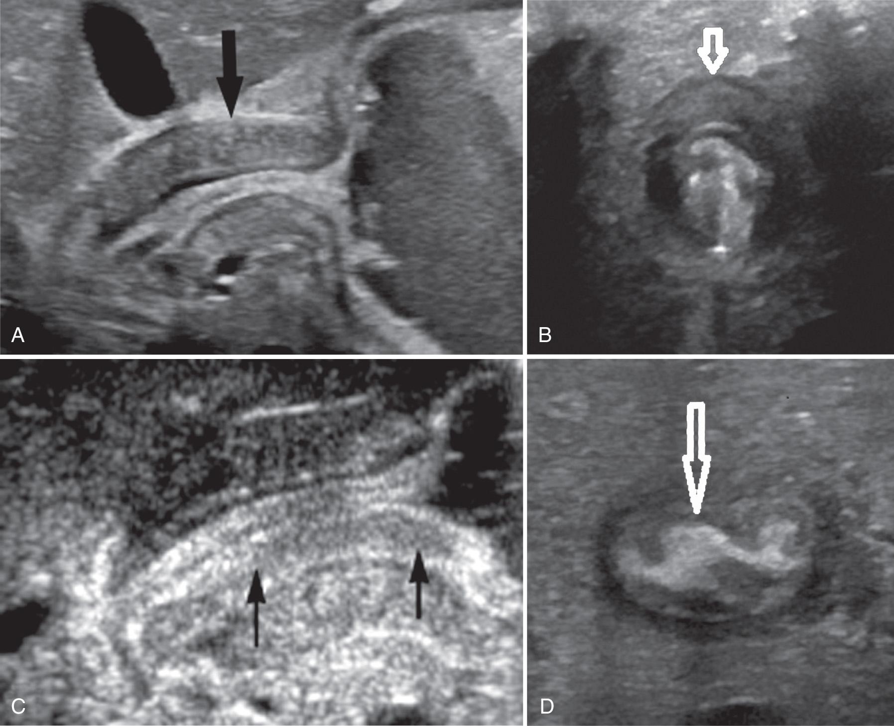 FIG. 53.5, Hypertrophic Pyloric Stenosis.