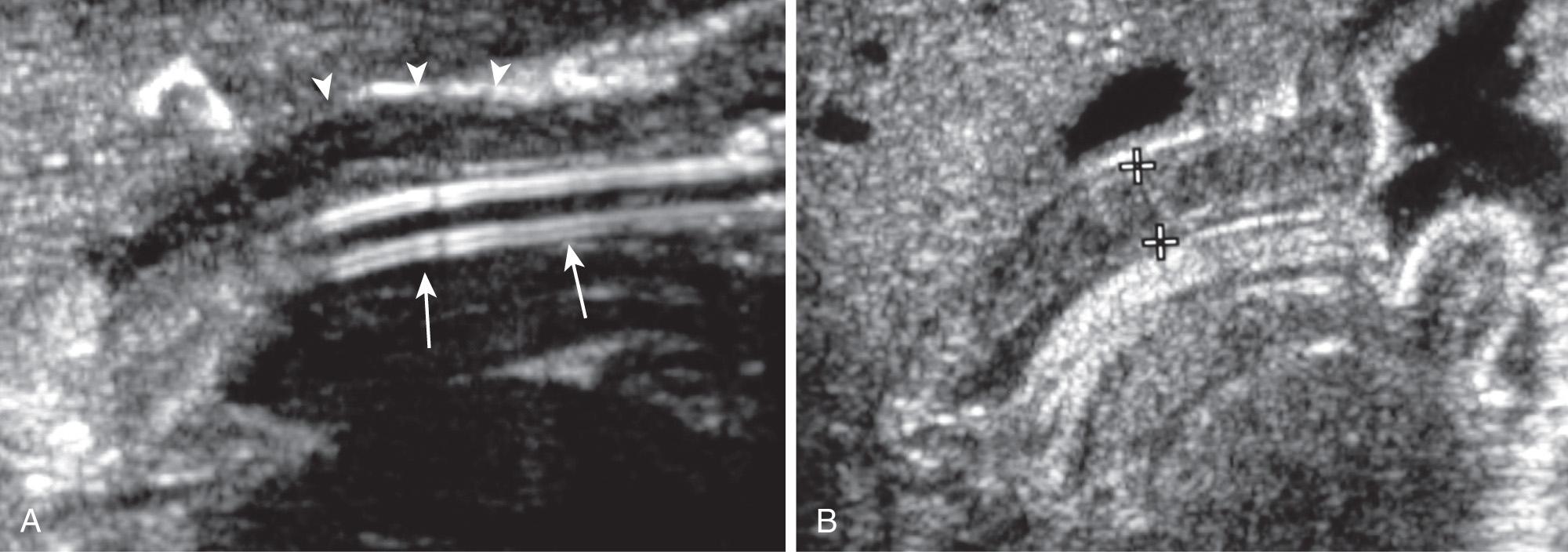 FIG. 53.6, Minimal Pyloric Muscle Thickening Progresses to Hypertrophic Pyloric Stenosis.