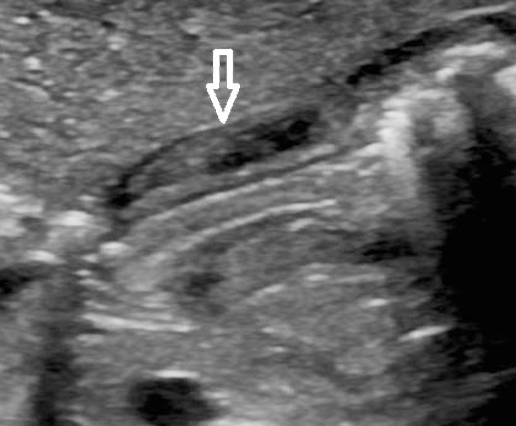 FIG. 53.7, Muscle Thickening After Pyloromyotomy.