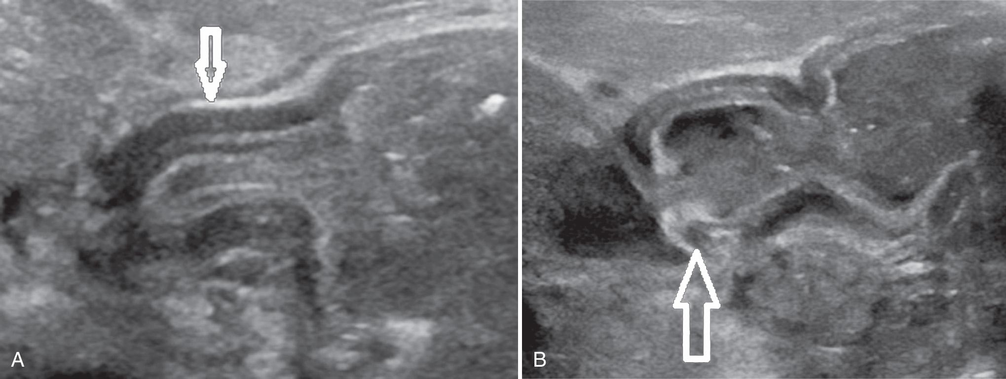 FIG. 53.8, Pylorospasm.