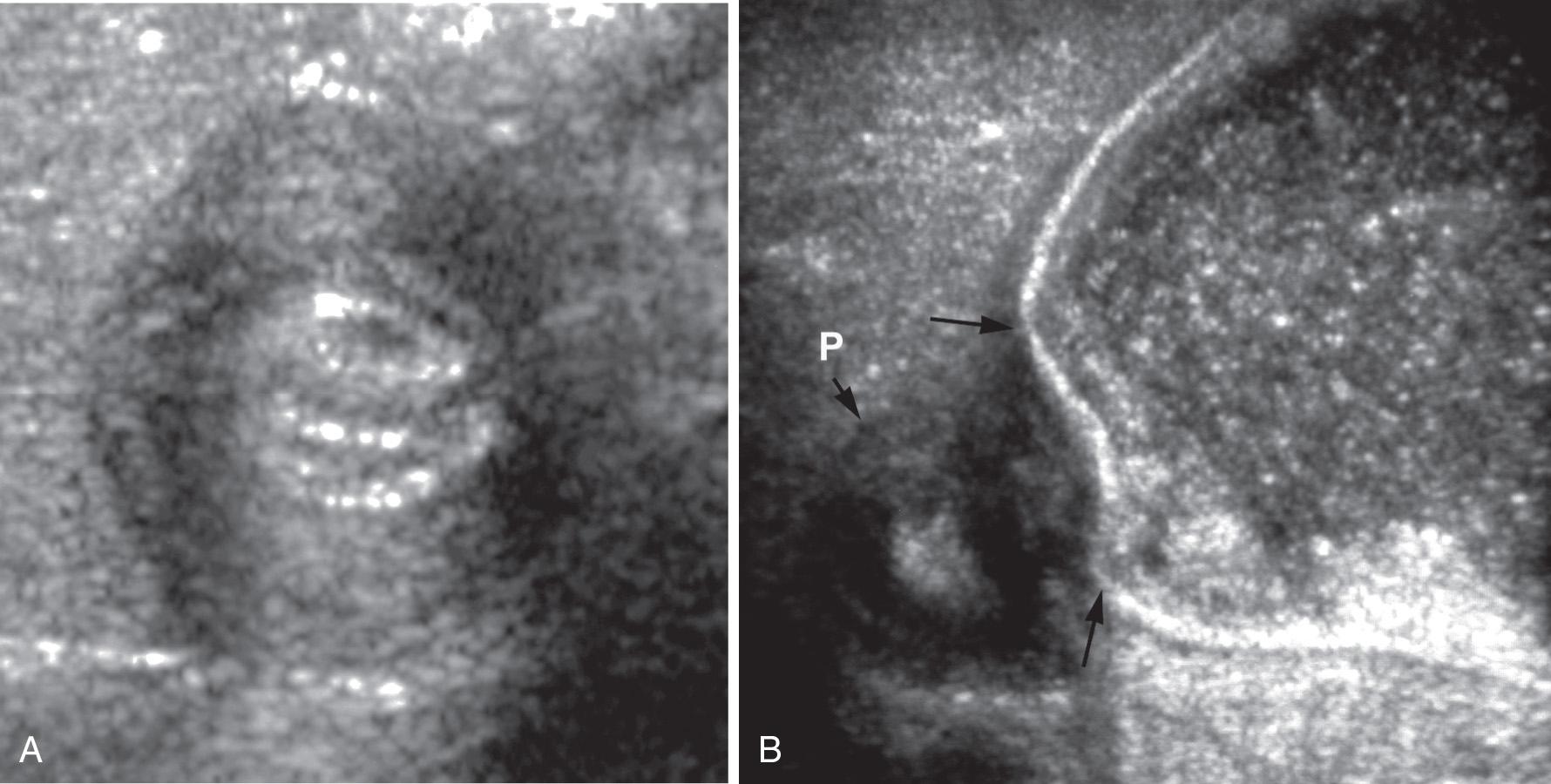 FIG. 53.9, Hypertrophic Pyloric Stenosis.