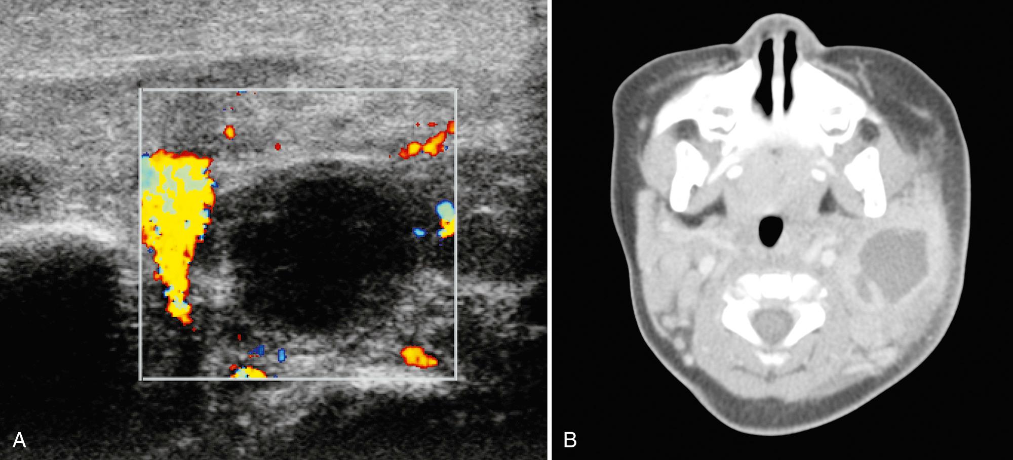 FIG. 48.11, Parotid Abscess.