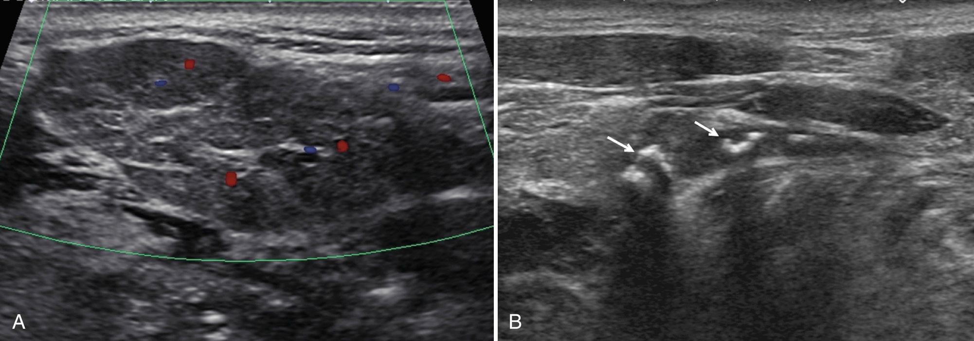 FIG. 48.12, Submandibular Gland Sialolithiasis.