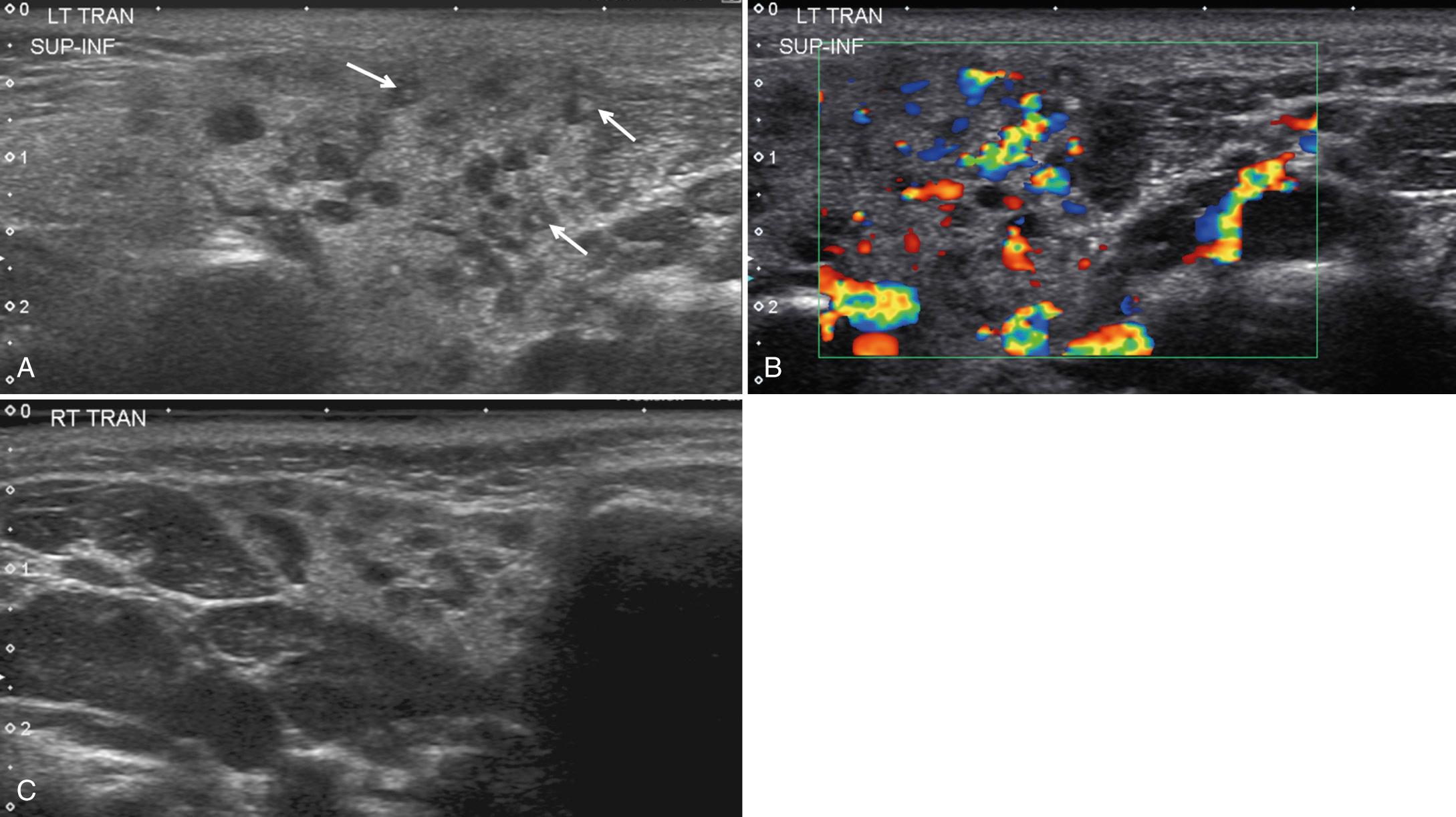 FIG. 48.13, Juvenile Recurrent Parotitis.