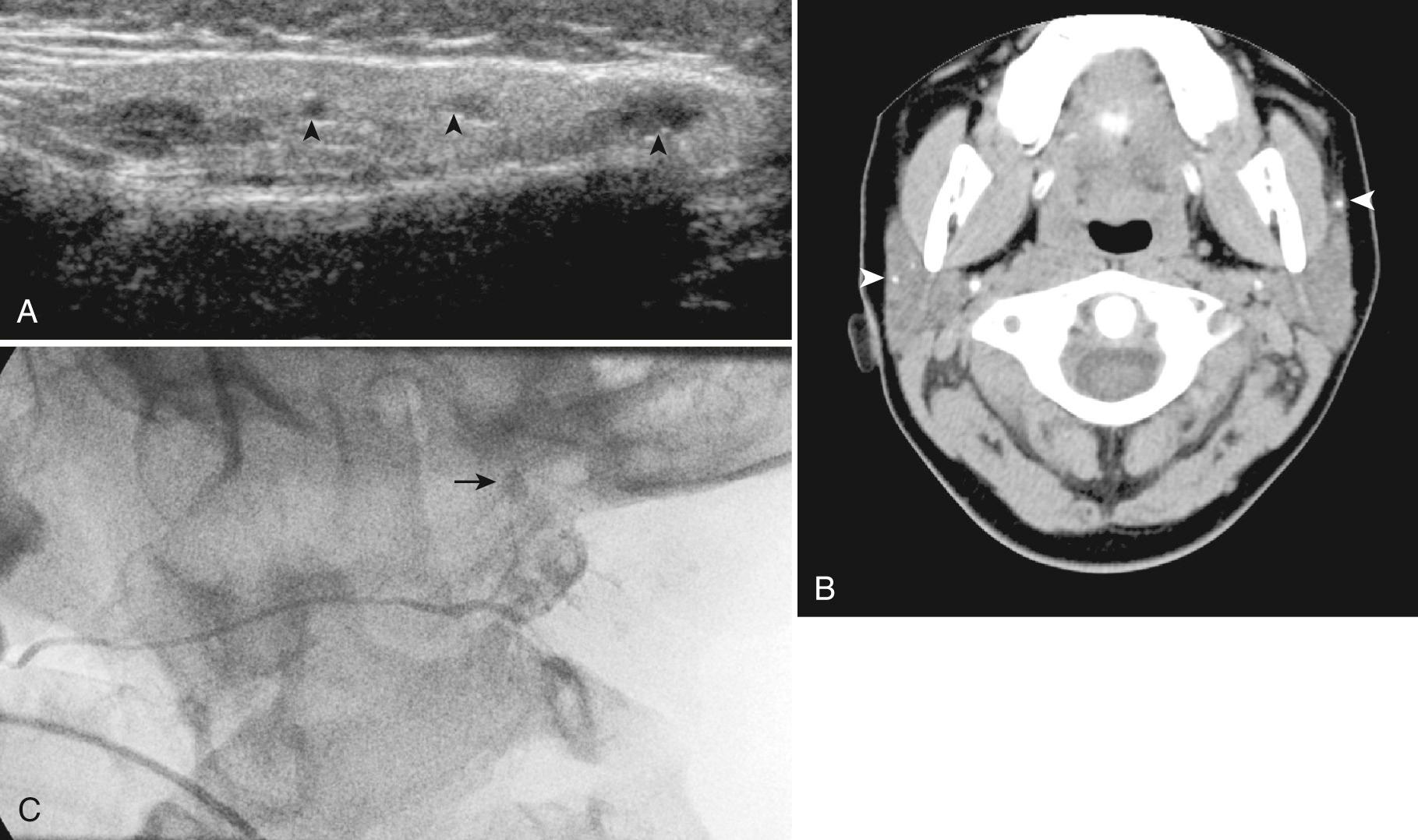 FIG. 48.14, Chronic Parotid Sialadenitis Secondary to Sialolithiasis.