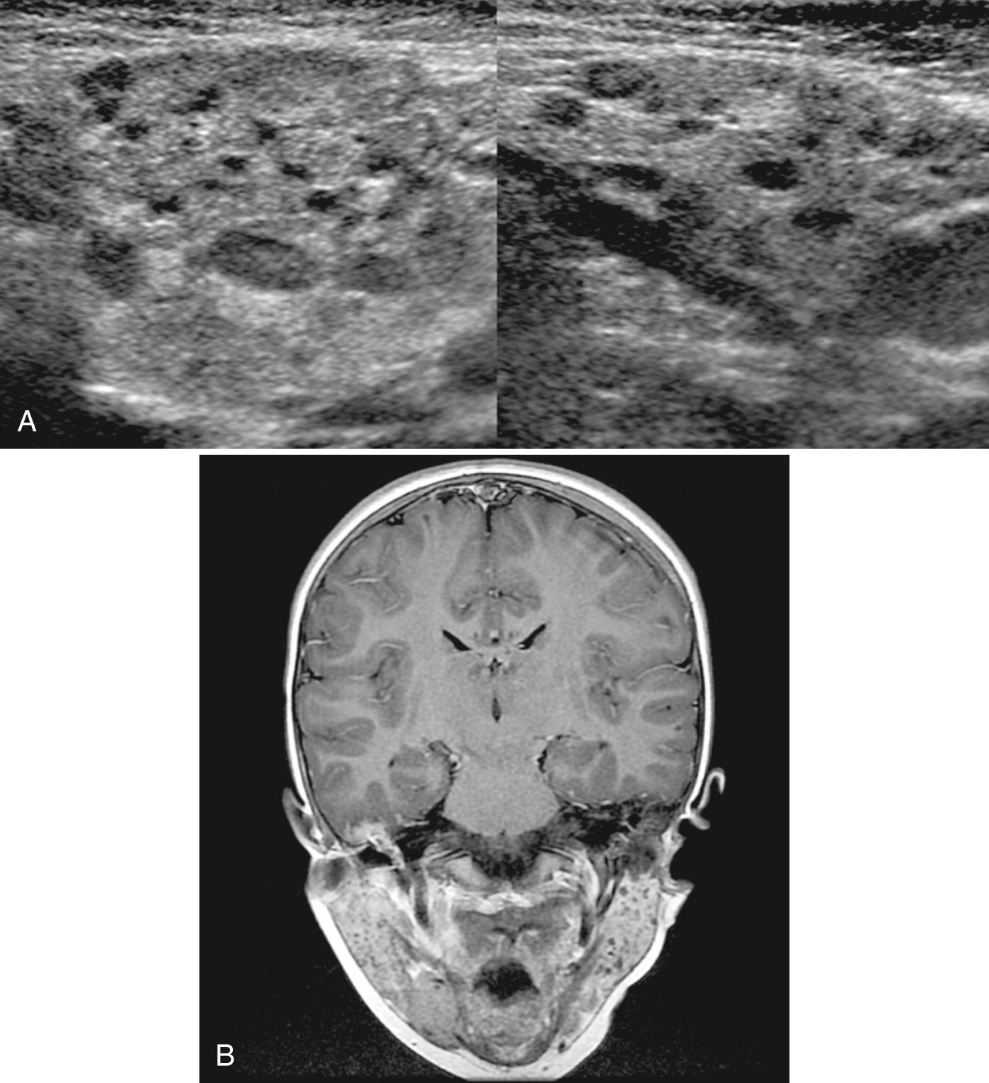 FIG. 48.15, Human Immunodeficiency Virus (HIV) Parotitis.