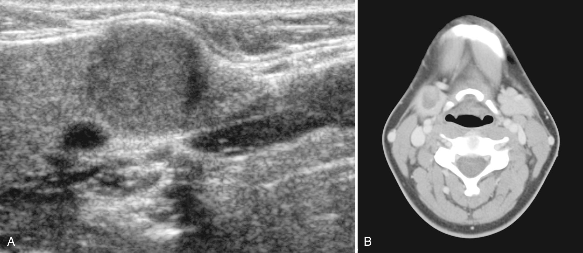 FIG. 48.18, Submandibular Pleomorphic Adenoma.