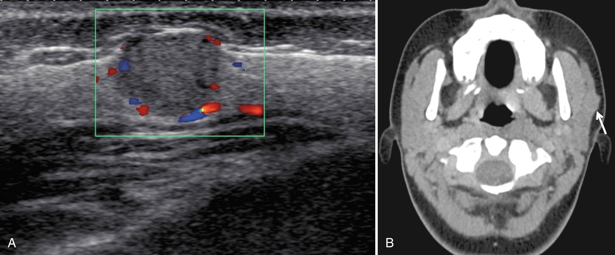 FIG. 48.19, Parotid Acinic Cell Carcinoma.