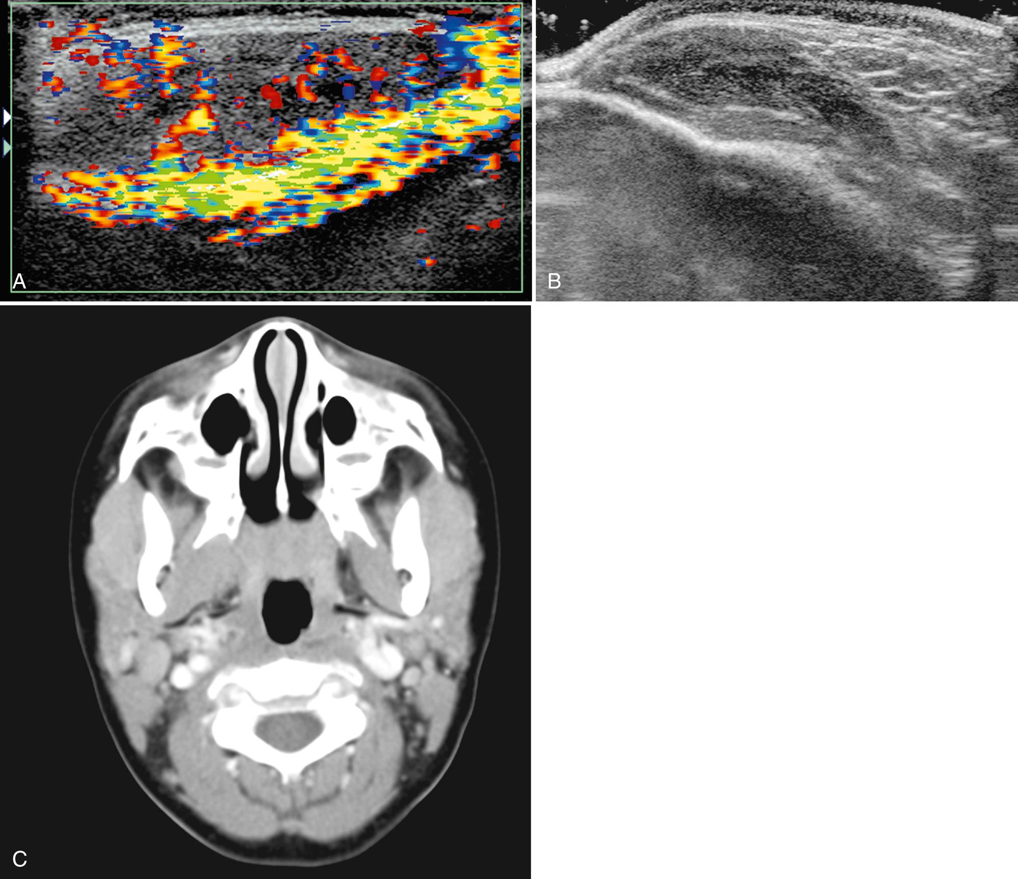 FIG. 48.22, Masseter Muscle Granulocytic Sarcoma (Chloroma).