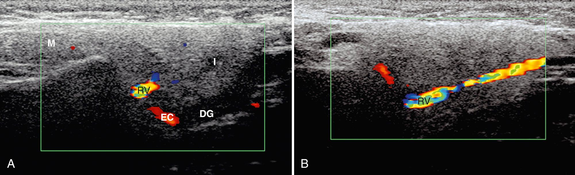 FIG. 48.5, Normal Parotid Gland.