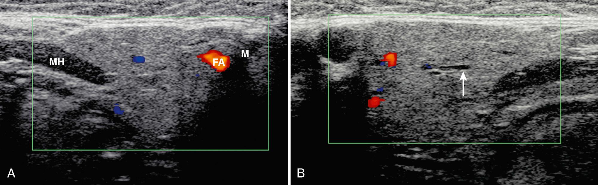 FIG. 48.7, Normal Submandibular Gland.