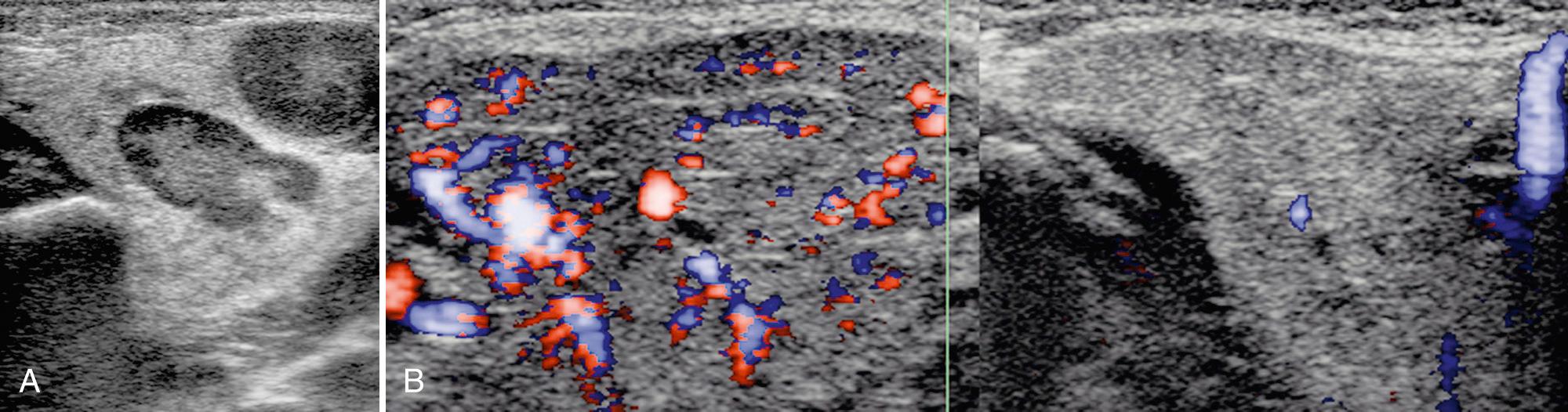 FIG. 48.9, Viral Salivary Gland Infection.