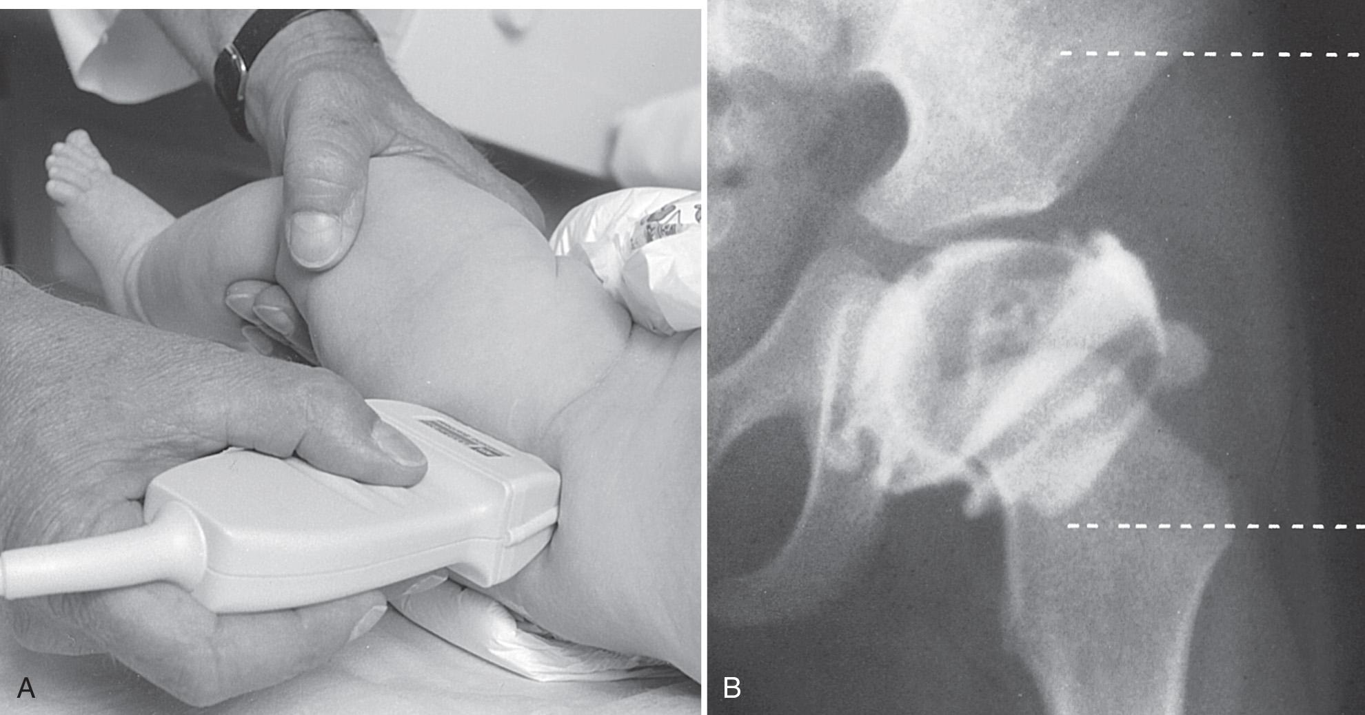 FIG. 55.1, Coronal/Neutral Hip View.