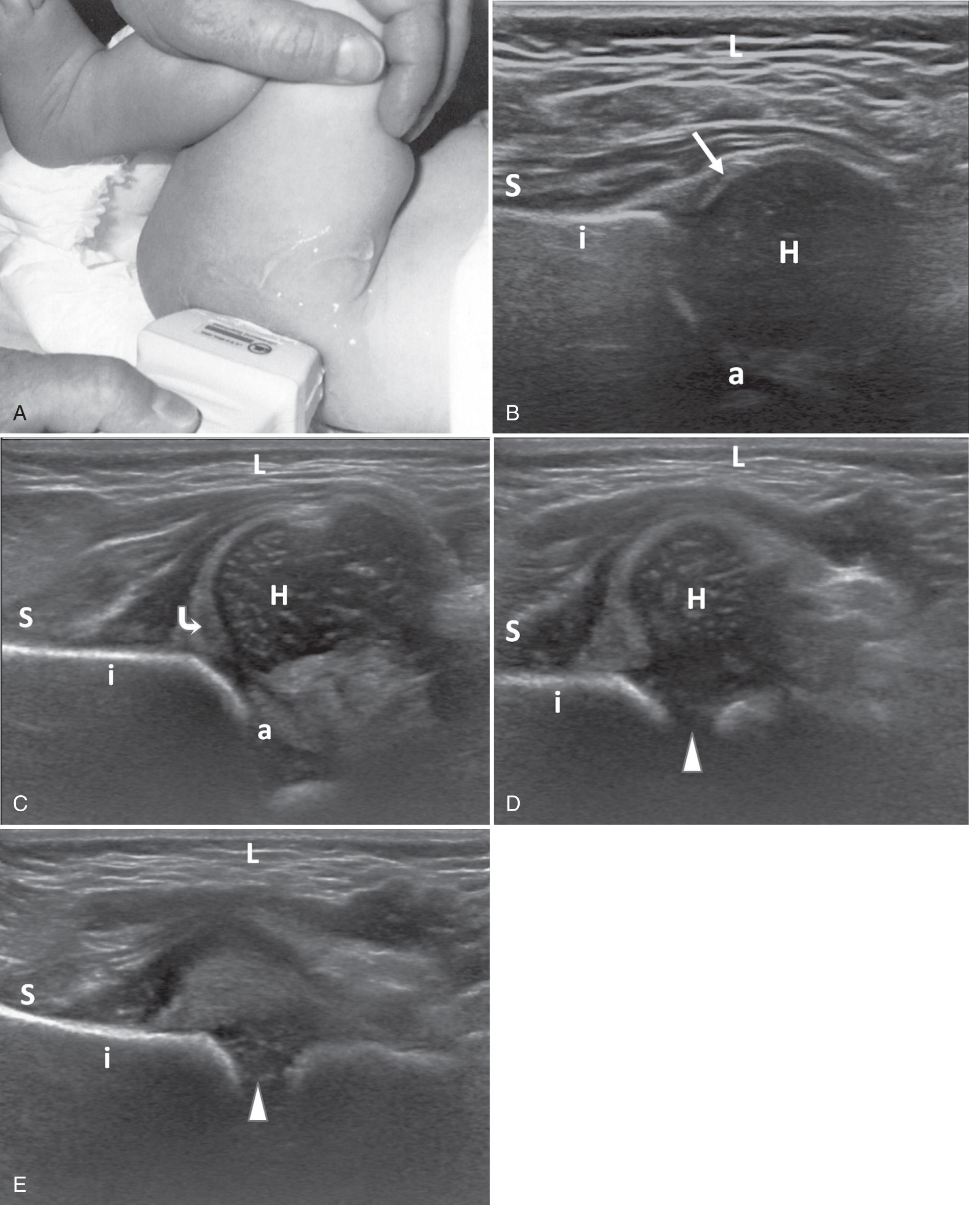 FIG. 55.2, Coronal/Flexion Hip Views.