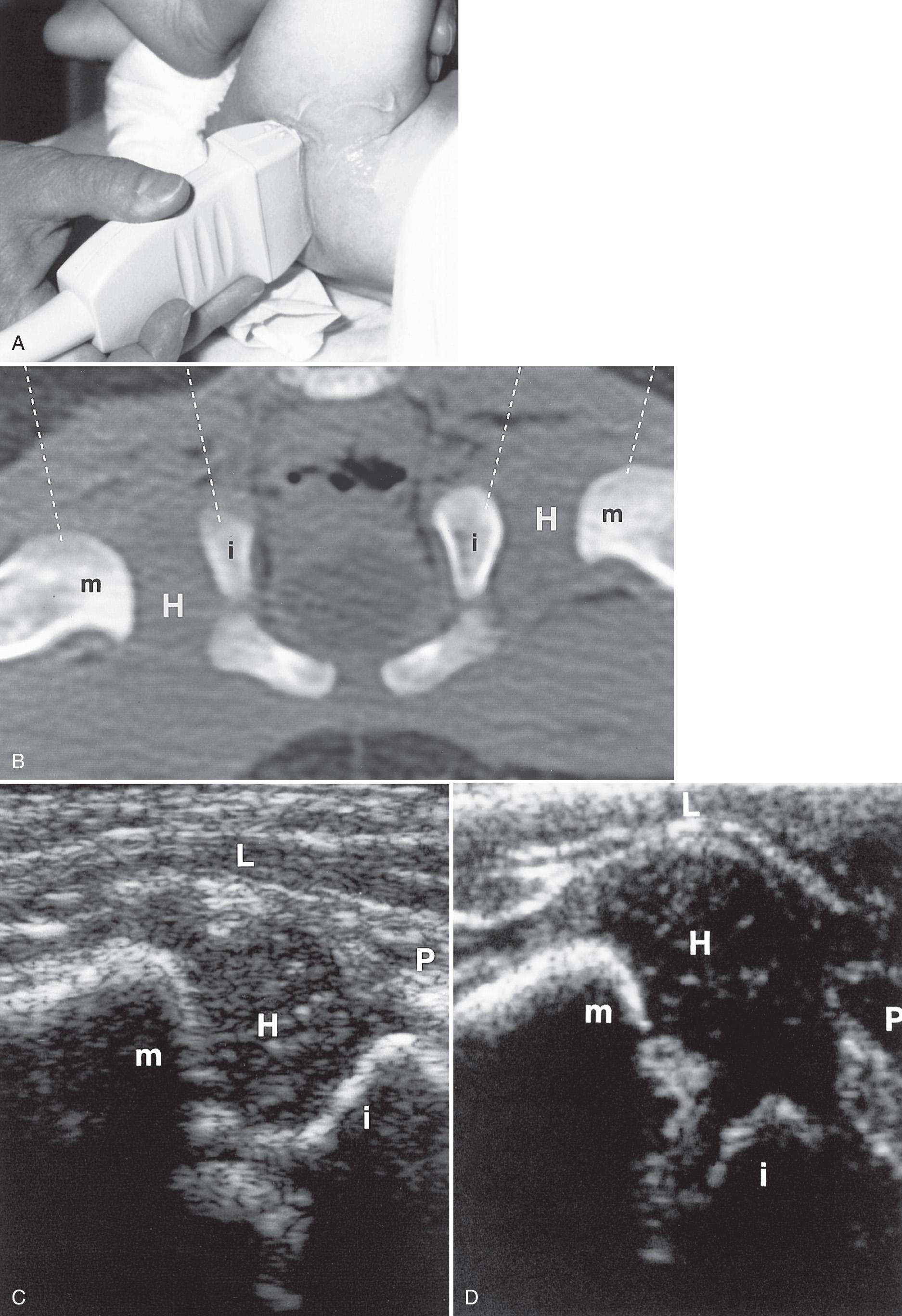 FIG. 55.3, Transverse/Flexion Hip View.