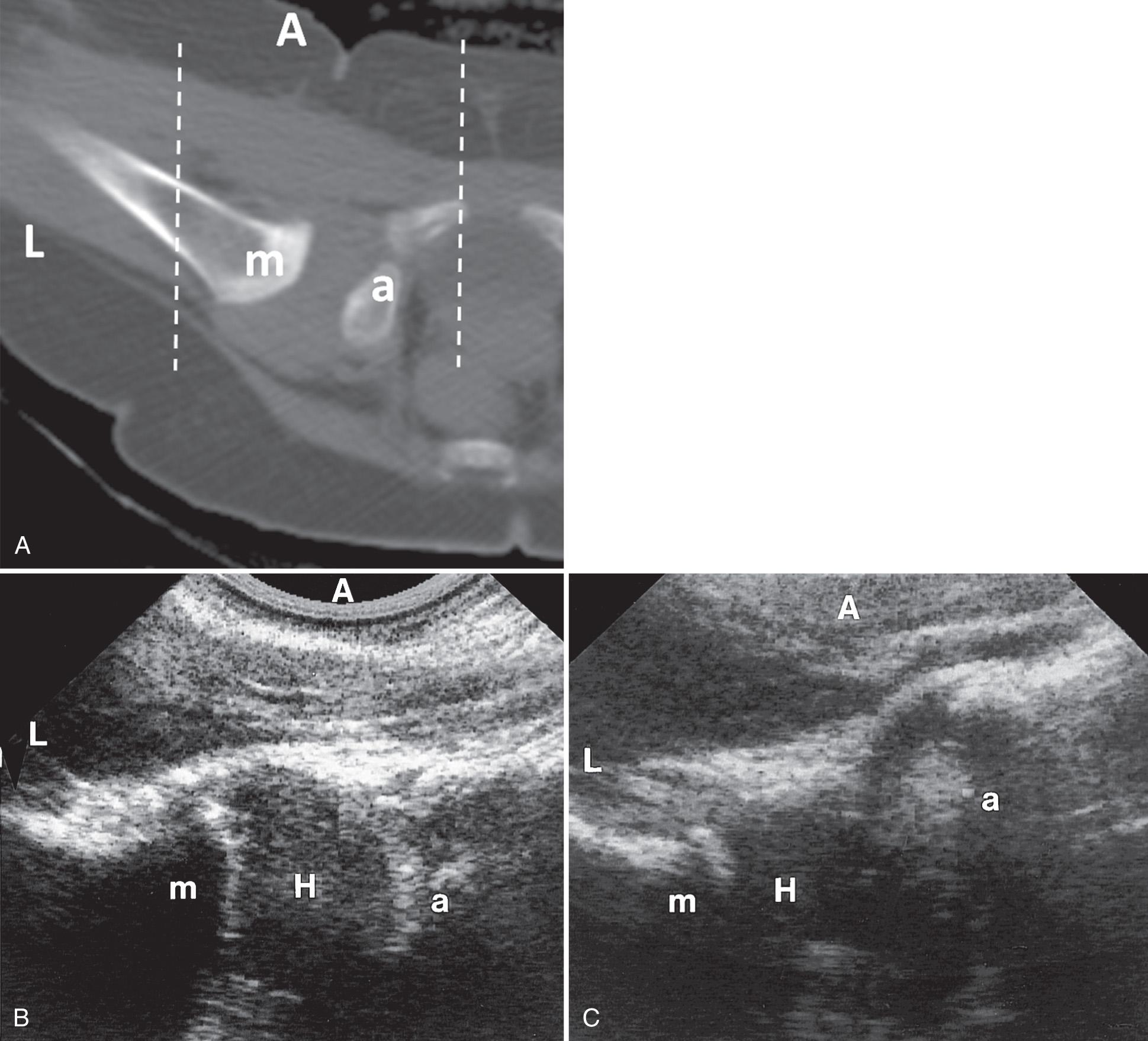 FIG. 55.4, Hip Anterior Views—Anterior Axial With Flexion and Abduction.