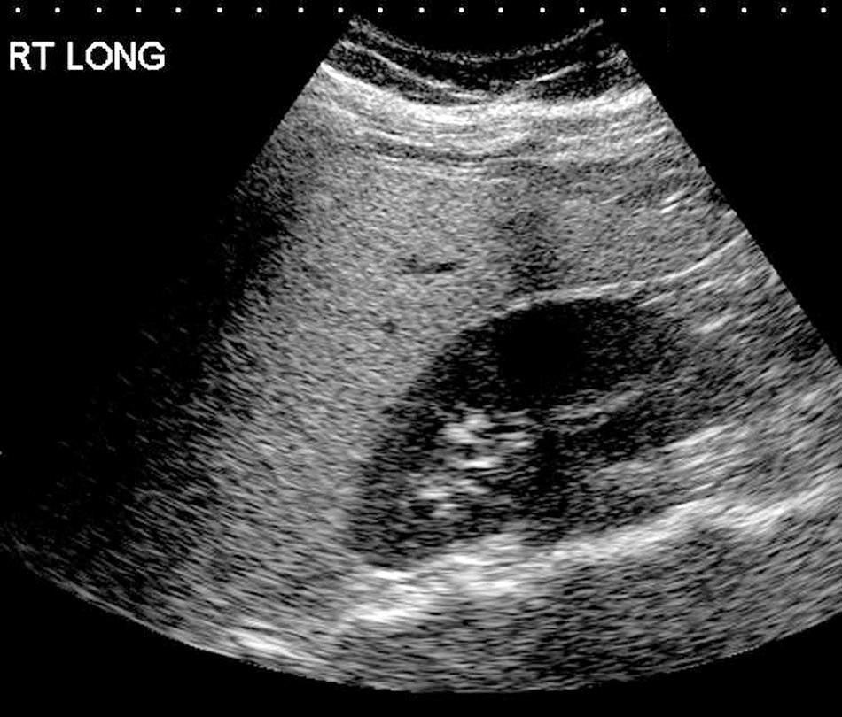 FIG. 51.11, Fatty Infiltration of Liver (Steatosis) in Patient With Cystic Fibrosis.