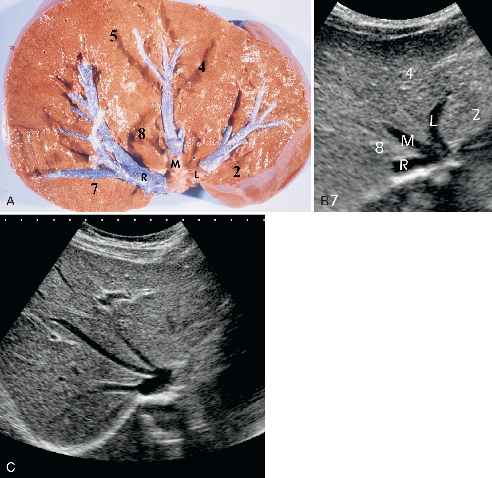 FIG. 51.4, Peripheral Borders of Segments: Hepatic Veins.