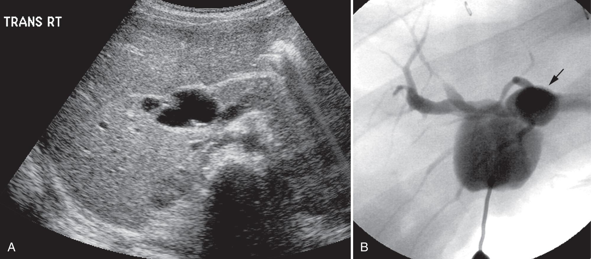 FIG. 51.6, Choledochal Cyst Type I in Infant With Jaundice.