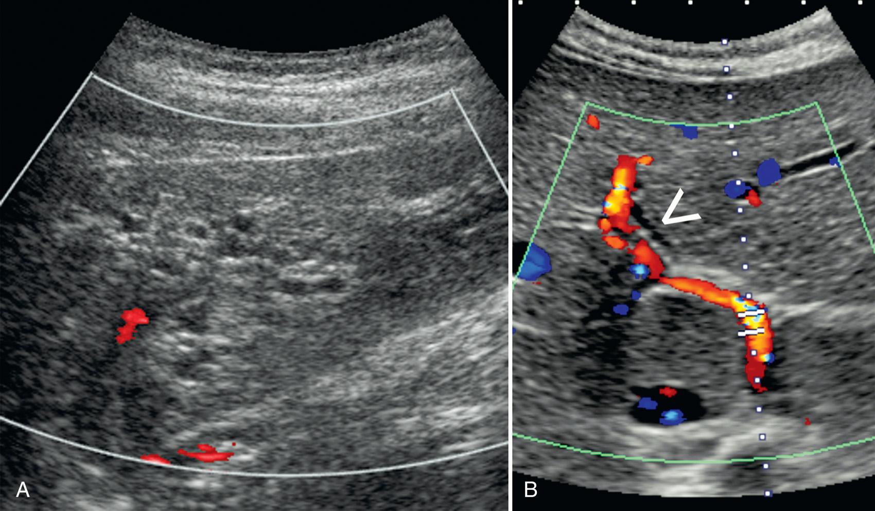 FIG. 51.7, Biliary Ductal Dilation.