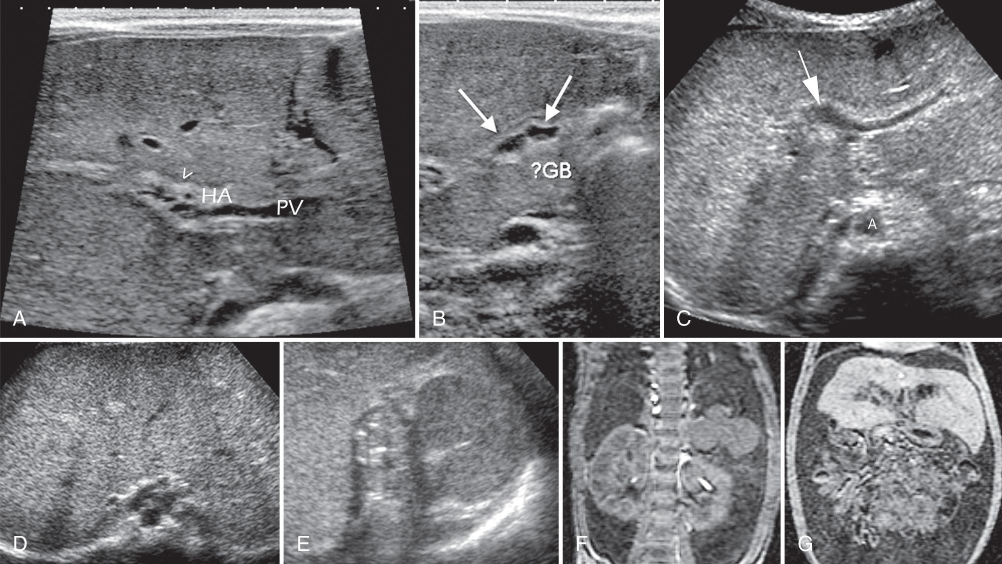 FIG. 51.8, Biliary Atresia Spectrum.