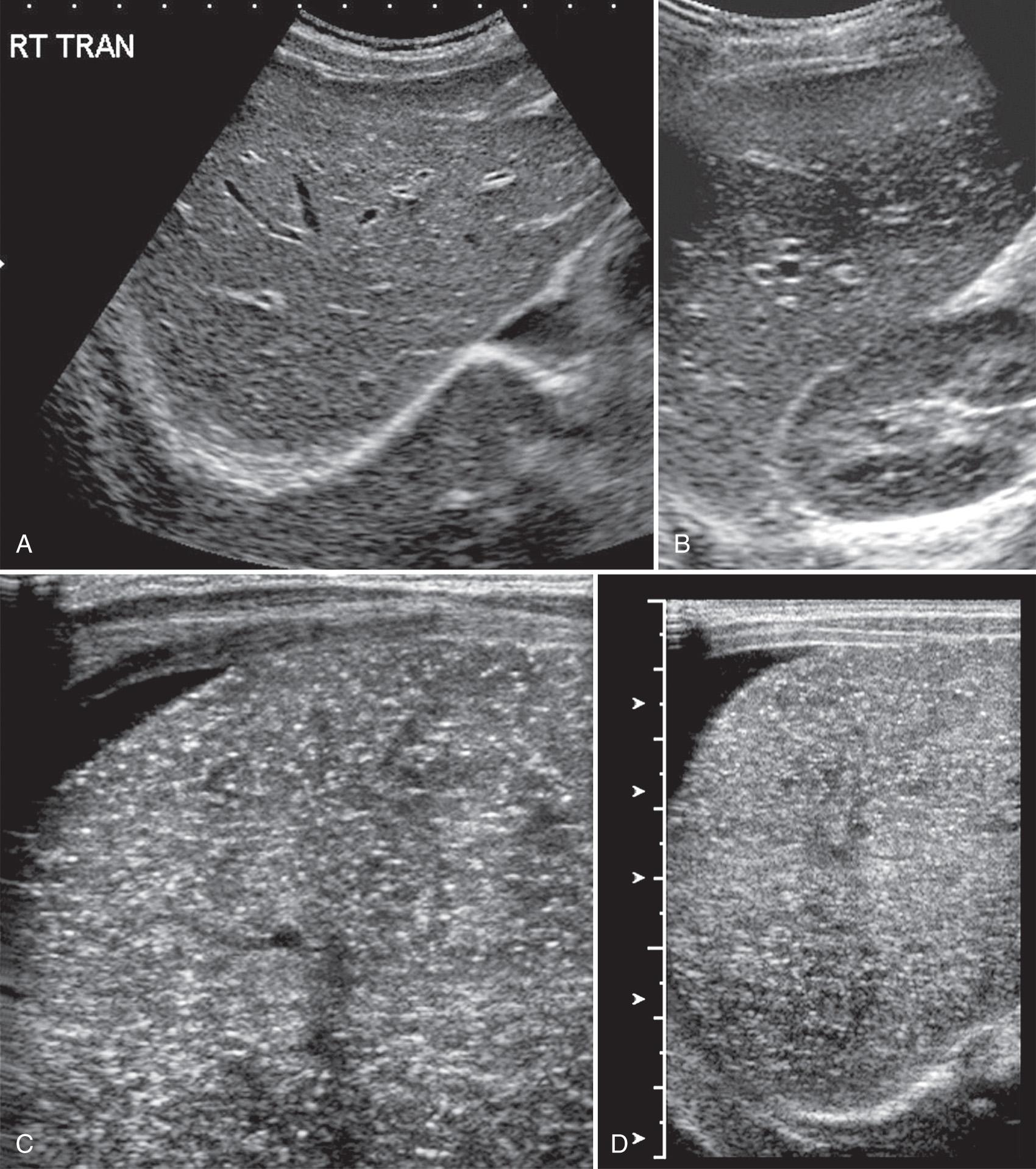 FIG. 51.9, Hepatitis.