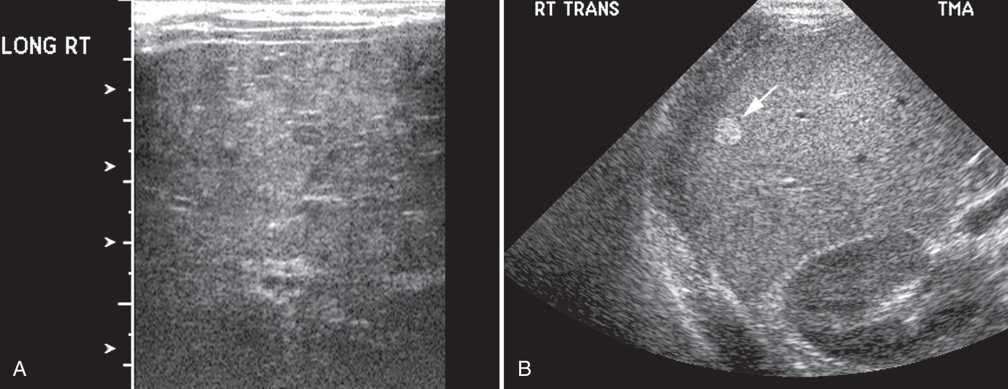 FIG. 51.10, Tyrosinemia and Glycogen Storage Disease (Type I, von Gierke Disease).